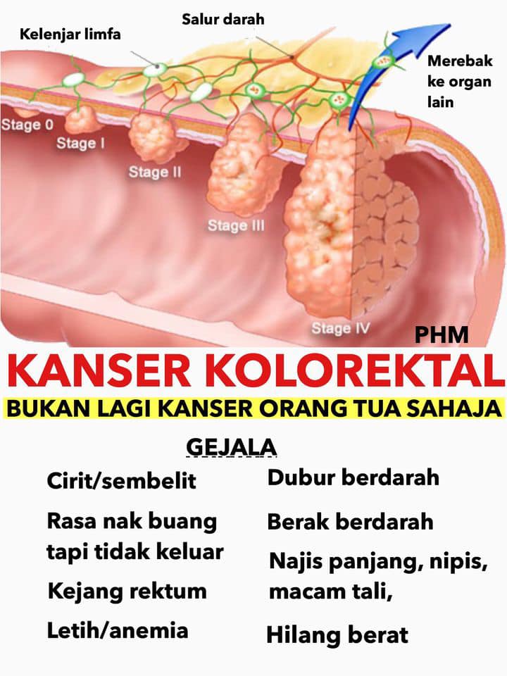 kanser kolorektal